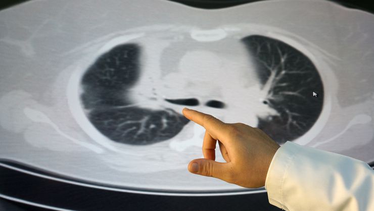akciğer kanseri
