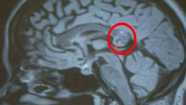 beyin tümörü