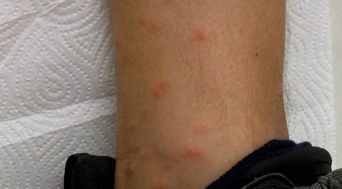 İstanbul'da sivrisinekler hastanelik etmeye başladı: 'Alerjik bireyler için riskli'