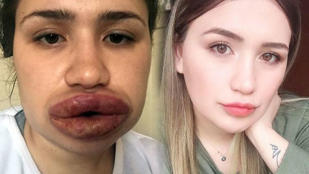 Kuaföre dudak dolgusu yaptıran Merve'nin doktoru: Dünyada görülmemiş bir vaka