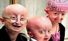 Progeria (Yaşlılık Hastalığı) Nedir?