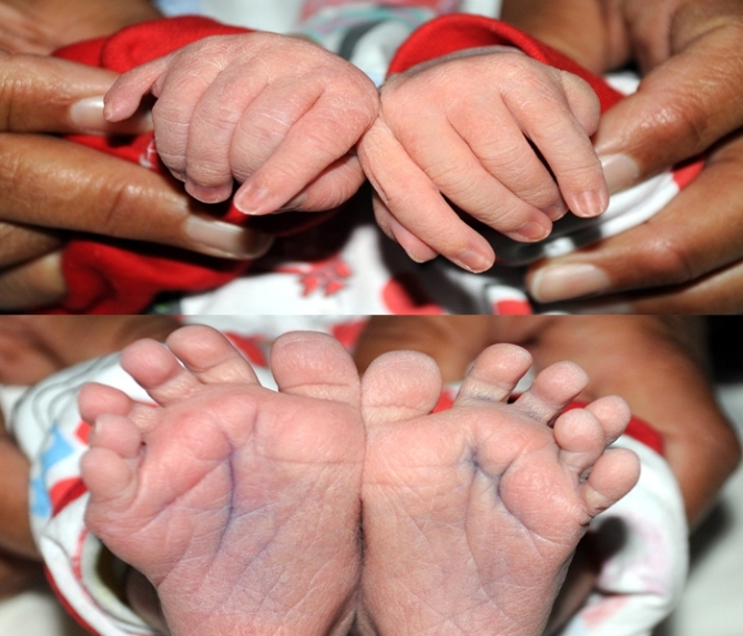 Şanlıurfa'da bebek 24 parmaklı doğdu!