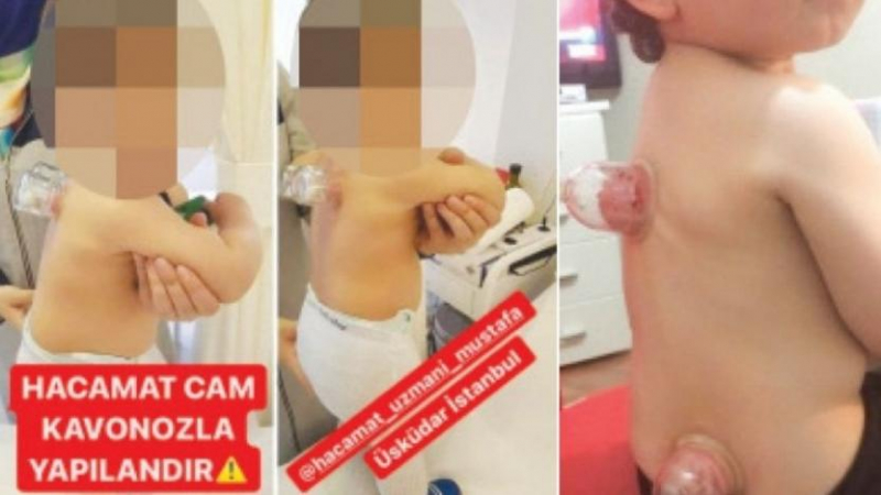Üsküdar'da bebeklere hacamat yapıldığı ortaya çıktı