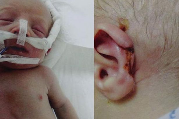 Yeni doğan bebeğin hastanede zarar gören kulağı koptu! 
